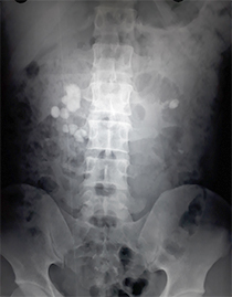 horseshoe kidney stone nephrolithiasis
